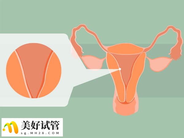 内异症会导致女性不孕
