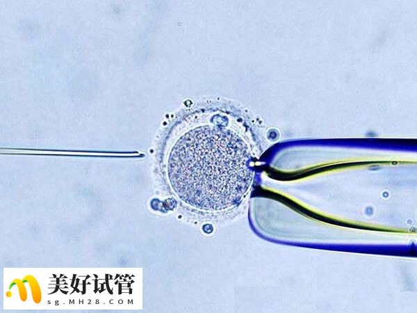 二代试管又叫单精子显微注射技术