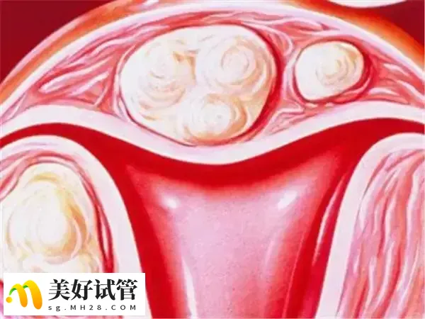 移植子宫内膜的厚度在20mm胚胎不易着床