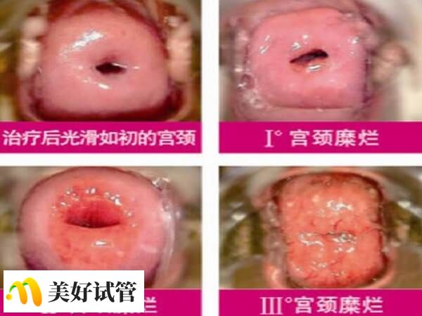 宫颈糜烂一度很有可能会转变为三度