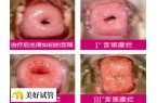 宫颈糜烂一二三度图片什么样